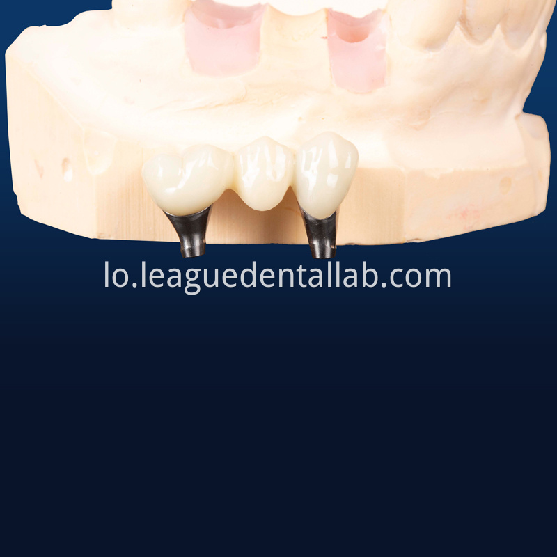 Dental Implant Crown, Dental Implant Zirconia crown,Dental Implant Emax crown,Dental Implant Bridge